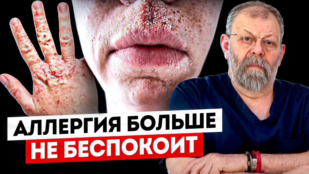 Всё про АЛЛЕРГИЮ. Как вылечить? Что делать? 3 способа воздействия на ...