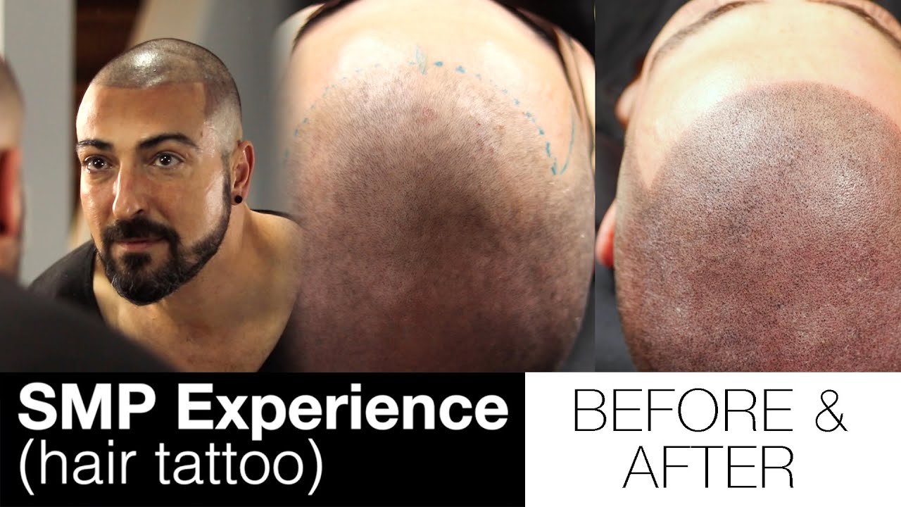 Scalp Micropigmentation Glendale Arizona  SMP hair tattoo clinic