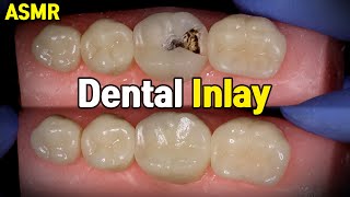 Dental Inlay Procedure