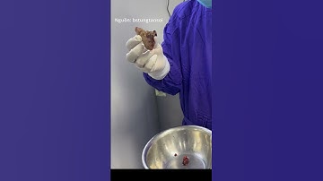 Nhìn xa cứ ngỡ là củ nghệ củ gừng nhưng sự thật là viên sỏi thận #soithan