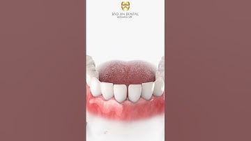 Niềng răng bằng khay trong suốt Invisalign  #baoandental