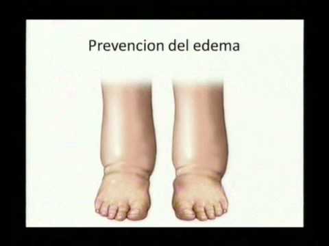medicos especializados internacionales Estadíos de enfermedades varicosas