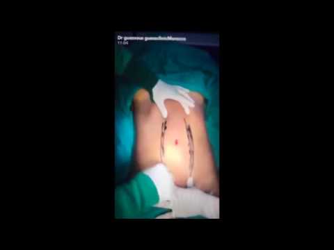 Vidéo: Les Chirurgiens Plasticiens Publient Des Procédures Sur Snapchat