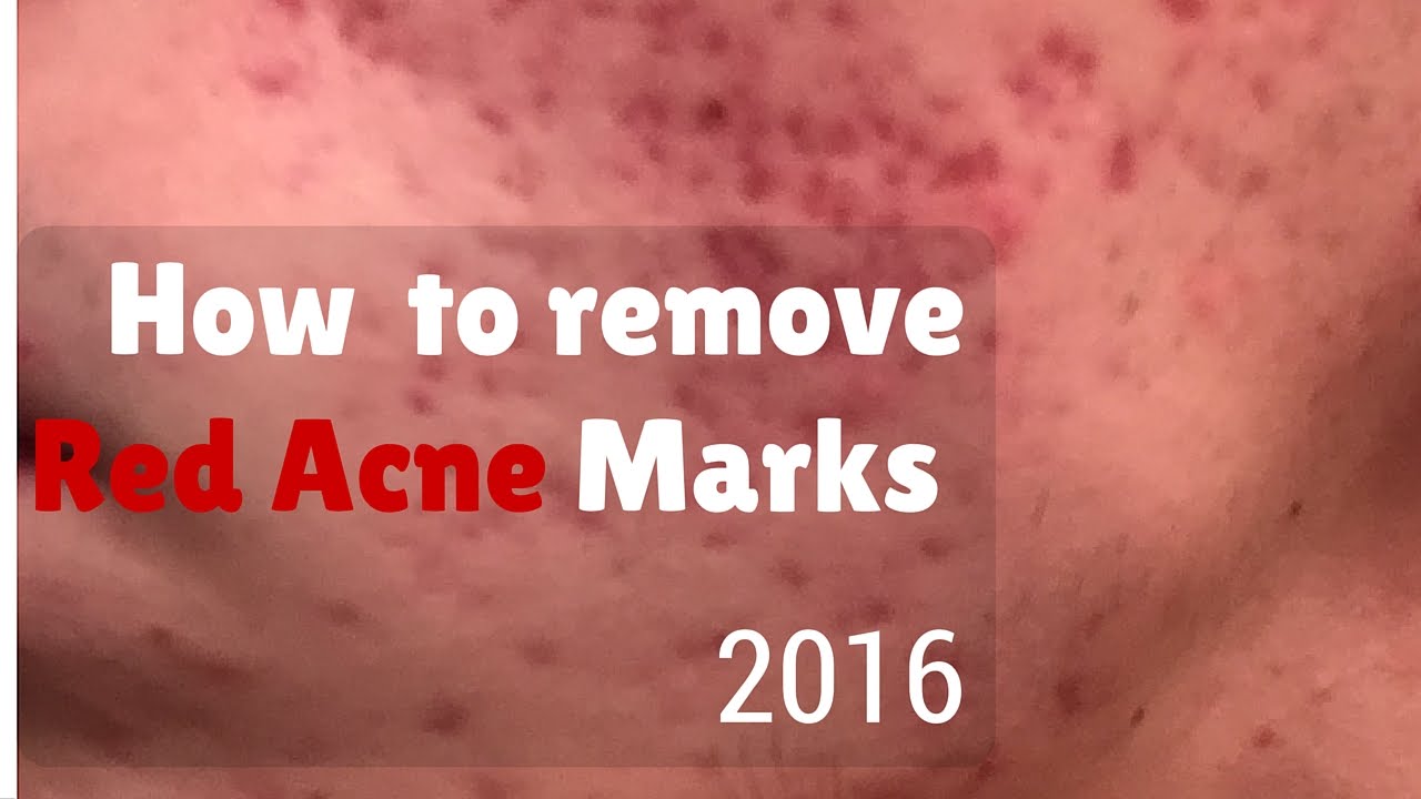 How to remove red marks from - YouTube