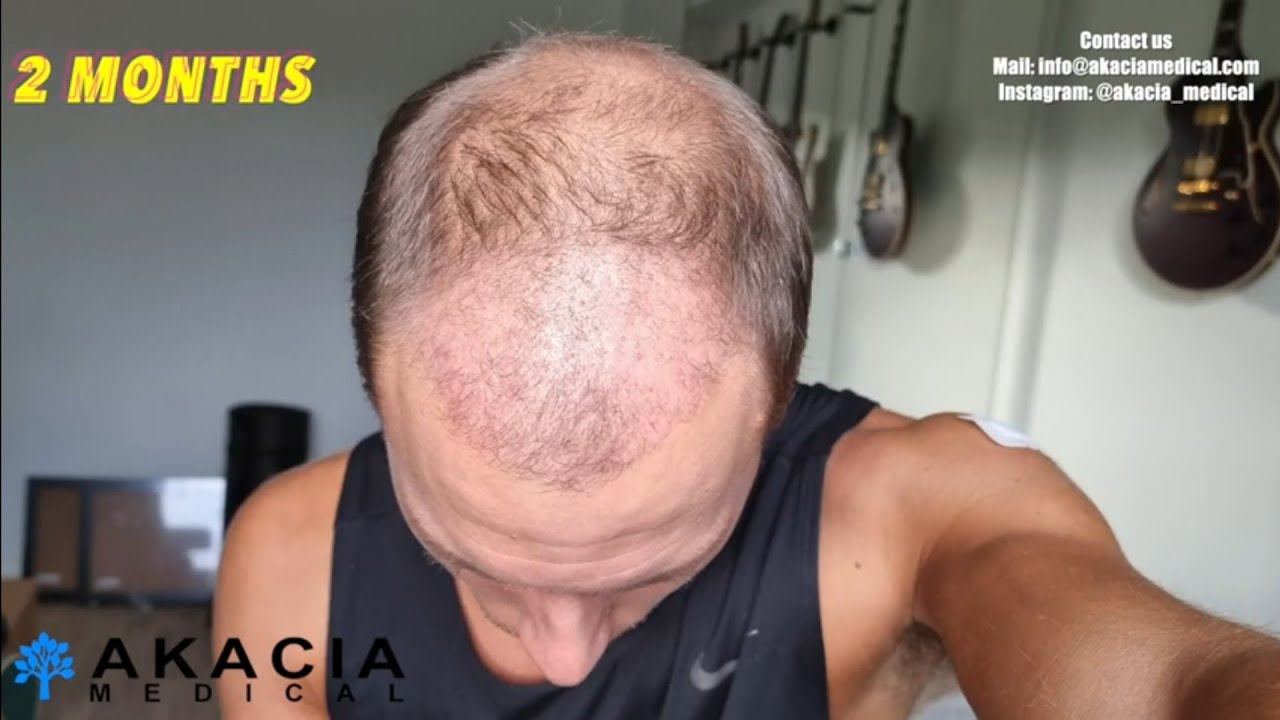 Hair Transplant Growth Timeline - the first 3 months!