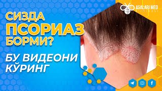 СИЗДА ПСОРИАЗ БОРМИ? ВИДЕОНГИ ОХИРИГАЧА КЎРИНГ. #saidatabiba  #asalarimed #psoriasis