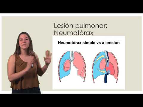Vídeo: Ubicaciones Anatómicas Del Aire Para El Diagnóstico Rápido De Neumotórax En Pacientes Con Traumatismo Cerrado
