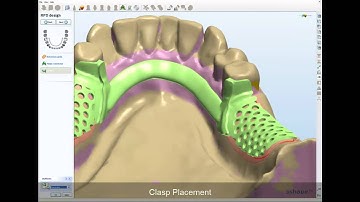 3Shape Removable Partial Framework Design - NEW 2010 - CadBluDental.com