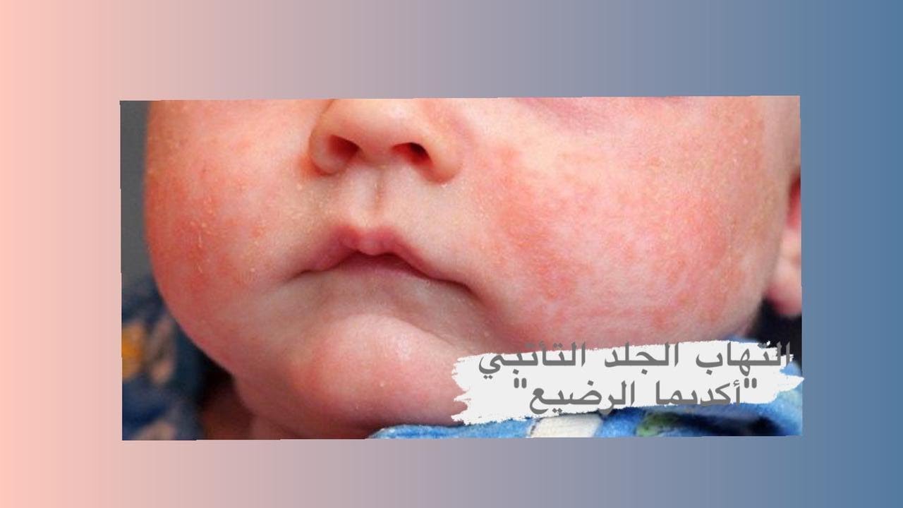 التهاب الجلد التأتبي أو أكزيما الرضيع