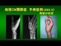 母指CM関節症 手術翌日の状況（2025 年12月手術）