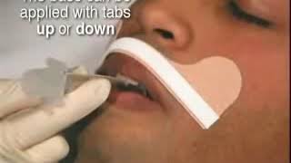Dale Endotracheal Tube Holder