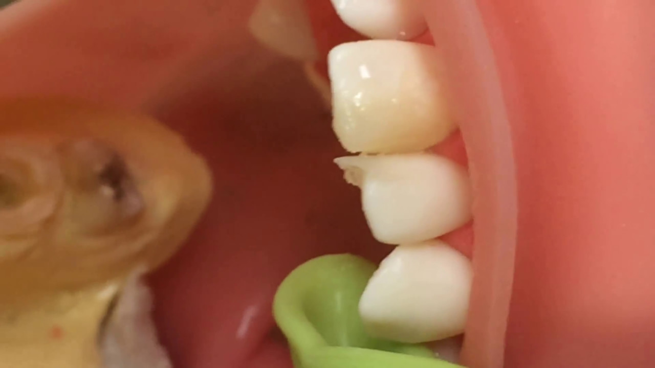 CR治療(10/14)形態修正の概要と口蓋側形態修正と咬合調整