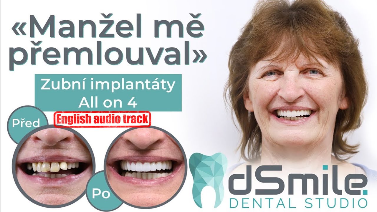 Nový úsměv za 1 návštěvu Zubní implantáty v Praze