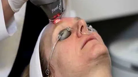 Fraxel® Laser Reduces Wrinkles and Brown Spots