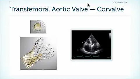 Assessment of Prostheses in Echocardiography