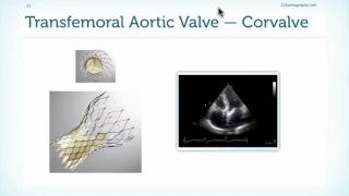 Assessment of Prostheses in Echocardiography