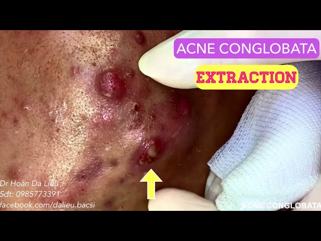 Mụn trứng cá mạch lươn cực nặng|Dermatologist,pimples,whitehead blackhead,acne conglobata extraction