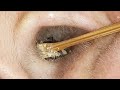 【耳掃除】#150 〜ミスったぁぁぁ😱…//『タモツの差し歯』とは!?〜 earwax