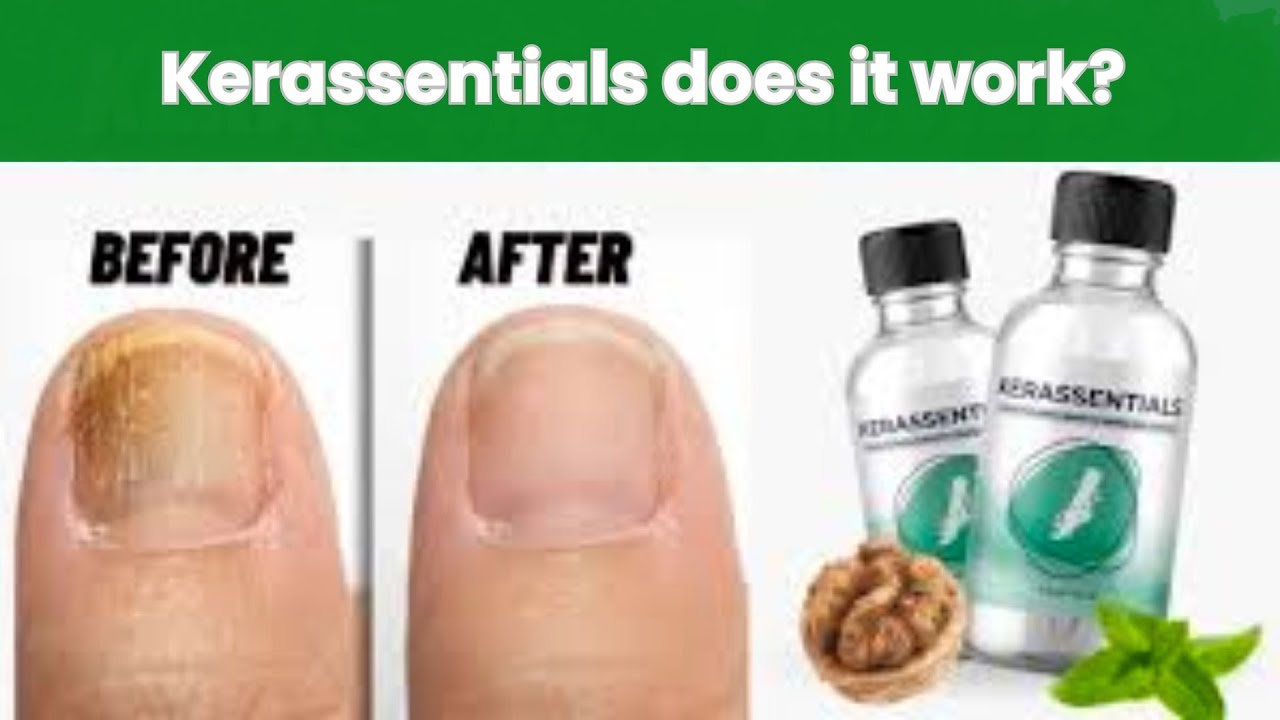 Kerassentials Natural Solution for Healthy Nails #nails #naturalsolutions #kerassentials