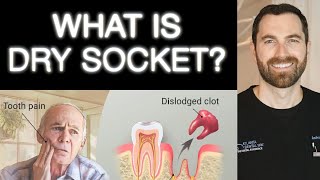 What is Dry Socket? Symptoms and how to fix it! (2022) Top dentist!