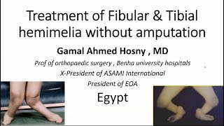 Treatment of Fibular & Tibial Hemimelia without amputation ( Prof Gamal Hosny ) screenshot 2