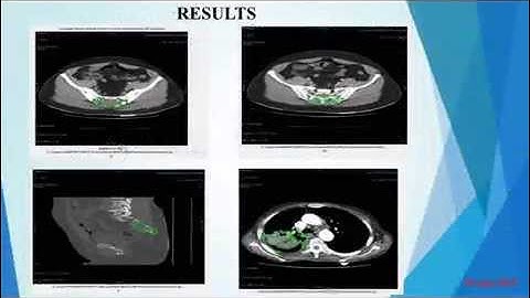 Computer Tomography Medical Image Segmentation using Level sets