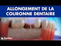 Allongement de la couronne dentaire ©