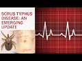 SCRUB TYPHUS DISEASE  - Symptoms /Diagnosis/prevention ചെള്ളുപനി  -  treatment
