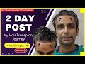 My Hair Transplant Journey, 2020 ( Day 2 Post Ops) | Dr Shail Gupta | Hair Transplant Results