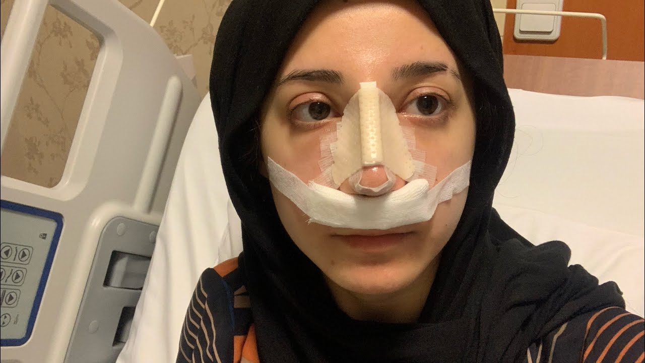 BURUN AMELİYATI OLDUM-Tüm sürecim ve merak edilenler