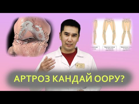 Video: Тизедеги оору кан уюп калышы мүмкүнбү?