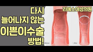재수술 걱정 줄여주는 이쁜이수술방법 - 더블반영구 질성형- 직접 3D애니메이션에 정창원 원장이 직접 설명드립니다다
