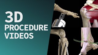 Start exploring a suite of 3D procedure videos in Complete Anatomy screenshot 1