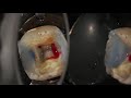 Complete endodontic treatment of a lower first molar step by step.