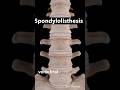 Spondylolisthesis #drt #paramedicaleducation #radiographer_course #spondylitis disease 🦠