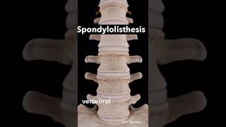 Spondylolisthesis #drt #paramedicaleducation #radiographer_course #spondylitis disease 🦠