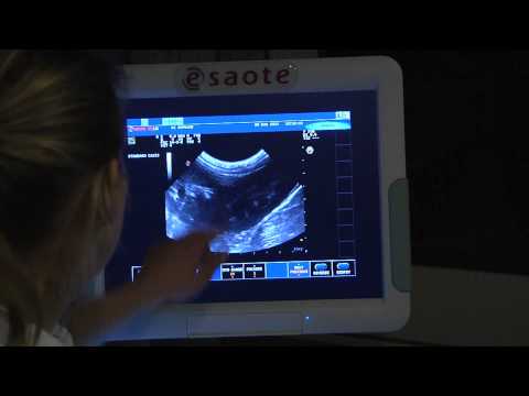 Video: Abdominale Echografie: Doel, Risico's En Procedure