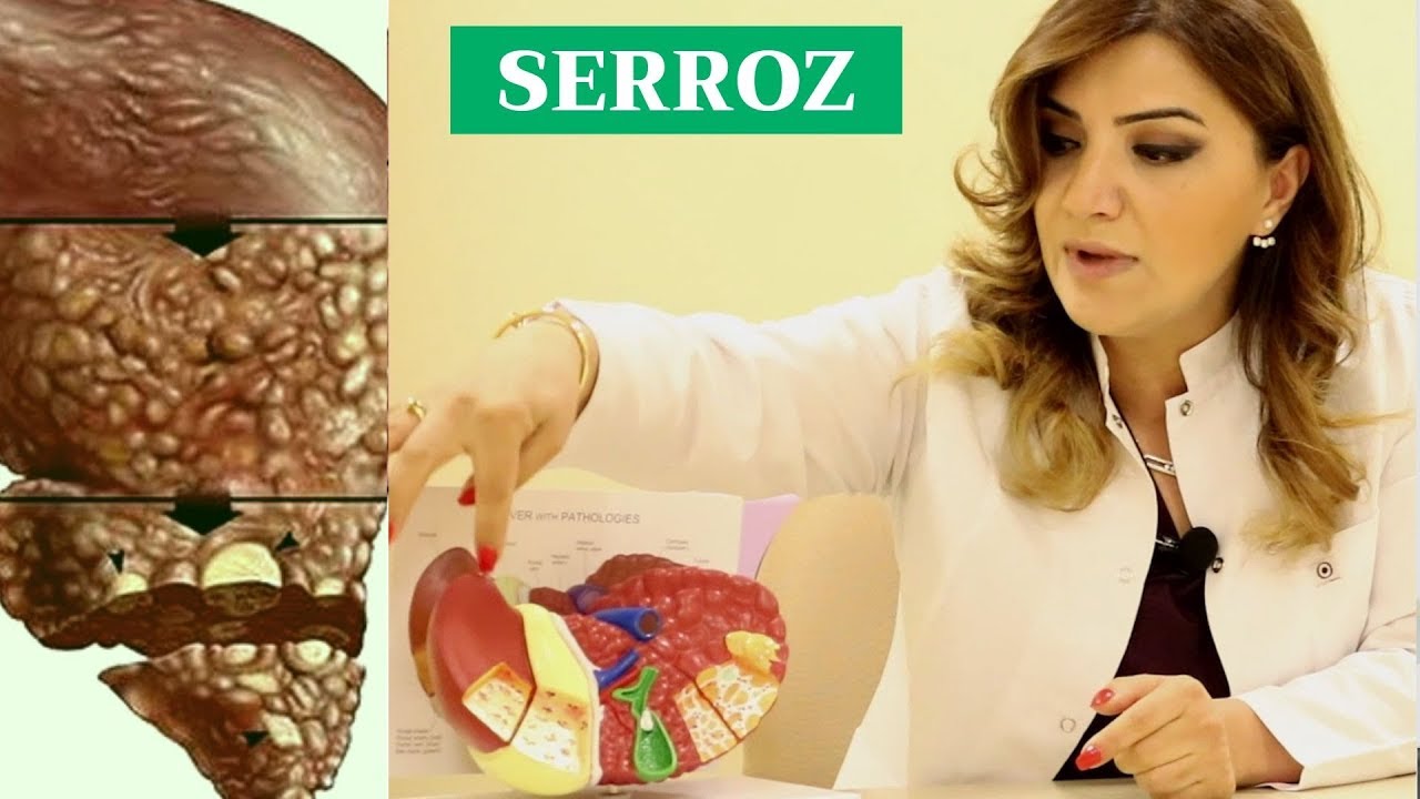 Qaraciyər serrozunun ilkin əlamətləri nələrdir?