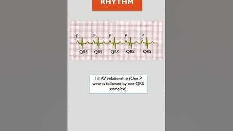 2:1 AV BLOCK || ECG COURSE || @LearningCardiology