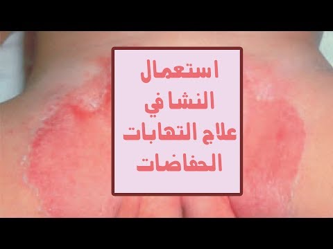 علاج التهابات الحفاضات بالنشا -  تسلخات الحفاض عند الرضع