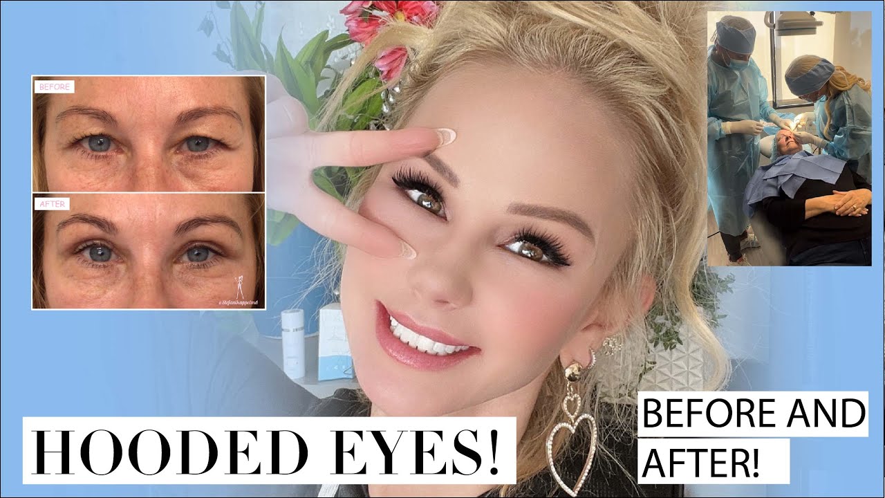 do-you-need-surgery-for-hooded-eyes-before-after-blepharoplasty