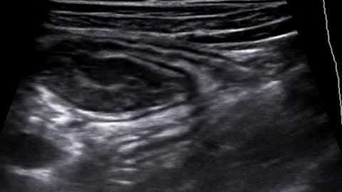 intussusception ultrasound video