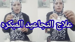 علاج-التجاعيد المبكرة