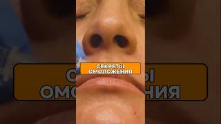 💉БЕЗ ОПЕРАЦИИ! ВСЁ о ФИЛЛЕРАХ и БОТОКСЕ – ЦЕНЫ, ЗОНЫ, РЕЗУЛЬТАТ ДО 4 ЛЕТ! #Косметология #Омоло #kl2