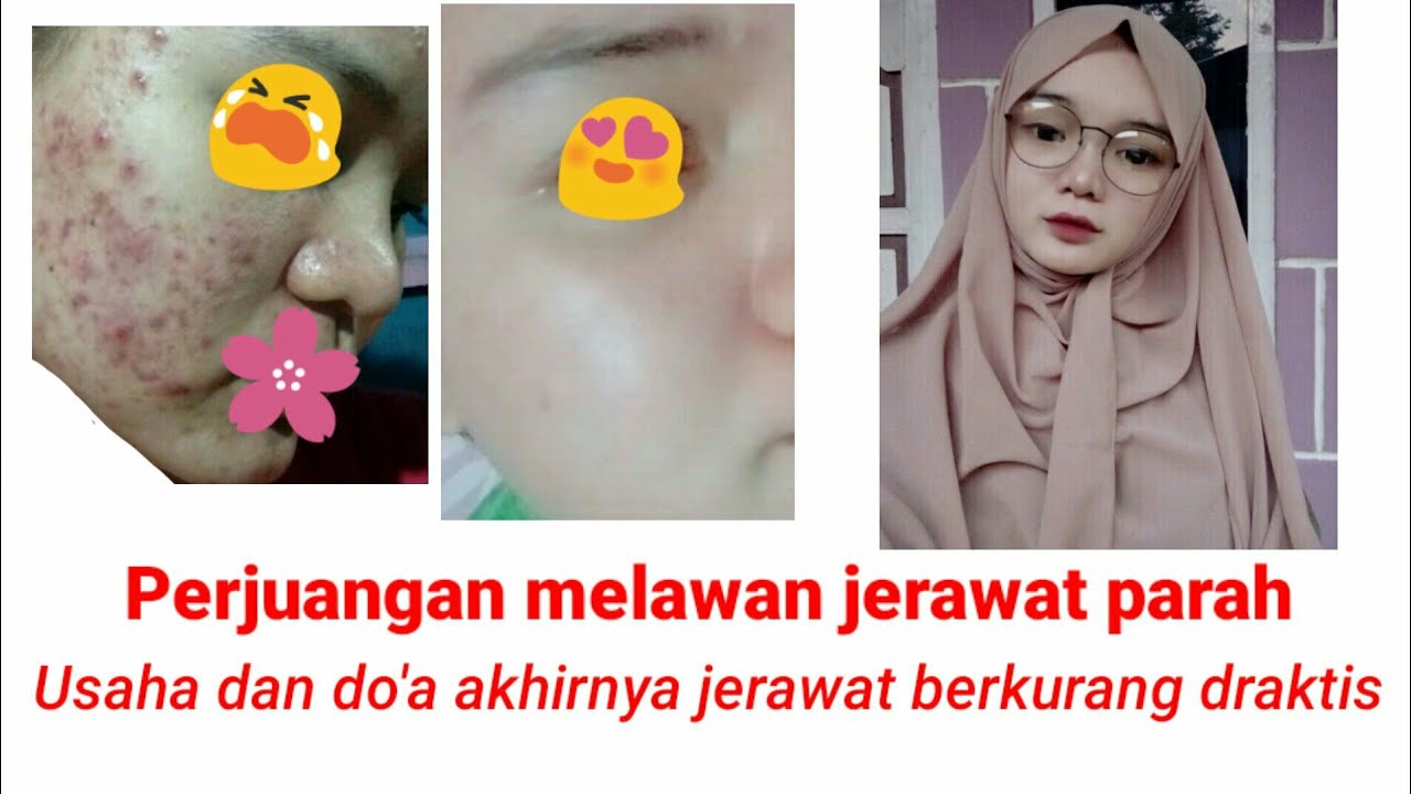 Cara menghilangkan jerawat dan bekas nya secara cepat