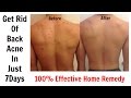 Get Rid Of Back Acne In Just 7 Days || 100% Effective Home Remedy