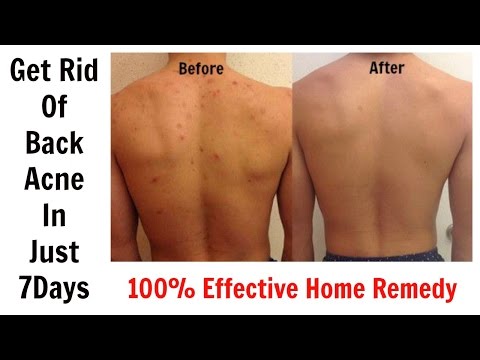 Get Rid Of Back Acne In Just  Days || % Effective Home Remedy