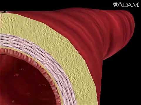 Video: Çfarë është ateroskleroza arterioskleroza dhe arterioloskleroza?