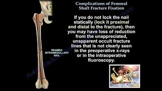 Complications Of Femoral Shaft Fracture Fixation - Everything You Need To Know - Dr. Nabil Ebraheim