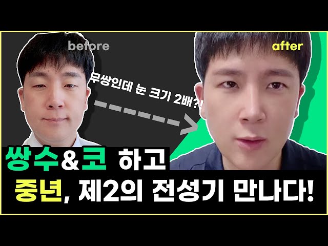 40대중년 남자, 쌍수+코하고 제2의 전성기로! | 비절개눈매교정, 코성형 Vlog